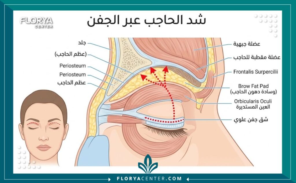 رسم توضيحي طبي لتشريح منطقة العين يوضح خطوات ومكان الشق الجراحي في عملية شد الحواجب عبر الجفن.