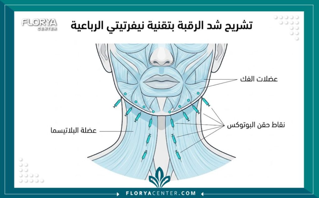مخطط تشريحي طبي يوضح عضلة البلاتيسما ونقاط حقن البوتوكس لشد الفك والرقبة باستخدام تقنية نيفرتيتي الرباعية.
