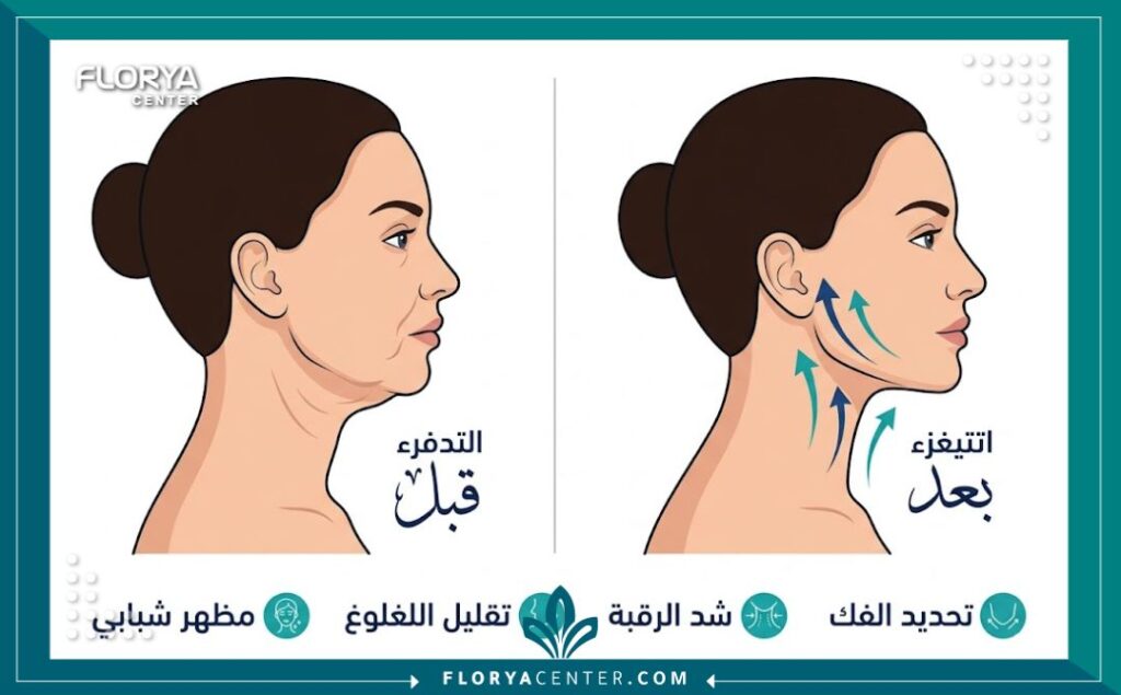 إنفوجرافيك يقارن بين مظهر الفك والرقبة قبل وبعد شد الرقبة بتقنية نيفرتيتي الرباعية في تركيا، موضحاً تحديد الفك وتقليل الترهل.