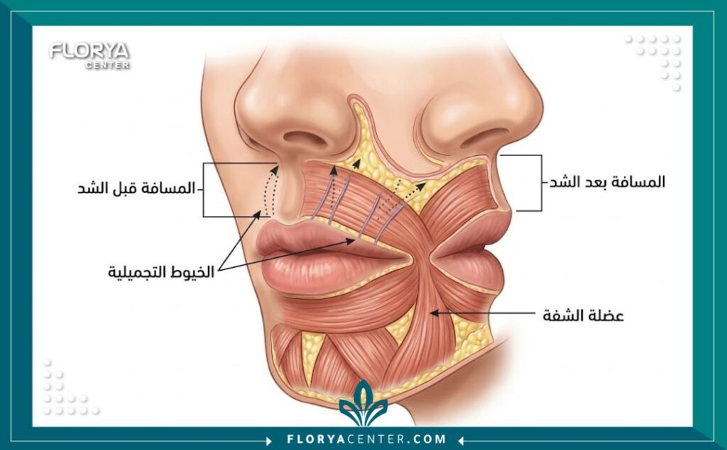 مخطط طبي توضيحي لكيفية عمل الخيوط في تقصير المسافة بين الأنف والشفة العلوية.