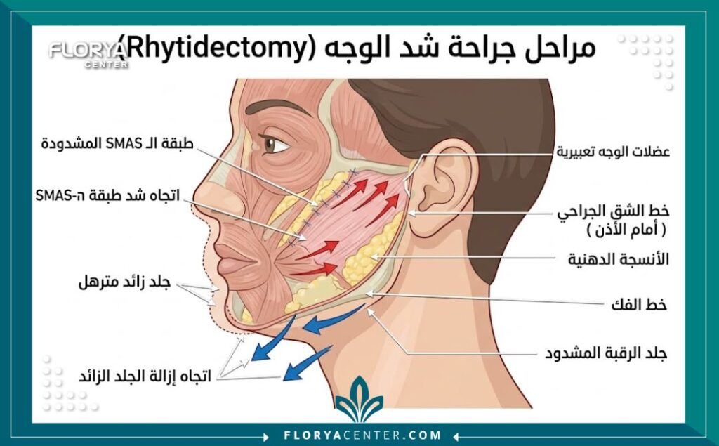 رسم تخطيطي طبي يوضح كيفية شد عضلات طبقة الـ SMAS وإزالة الجلد الزائد في عملية شد الوجه الكامل