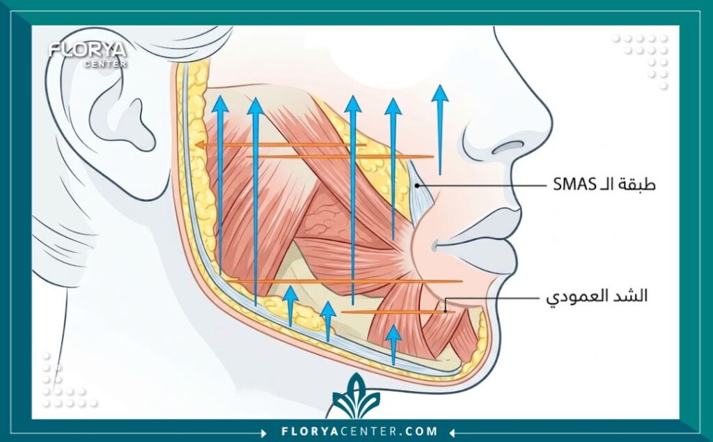 شد الوجه بتقنية الـ Vertical Vector 2 رسم تخطيطي طبي لطبقات الوجه يوضح اتجاه تقنية شد الفيكتور العمودي ومحاربة ترهلات الجاذبية.