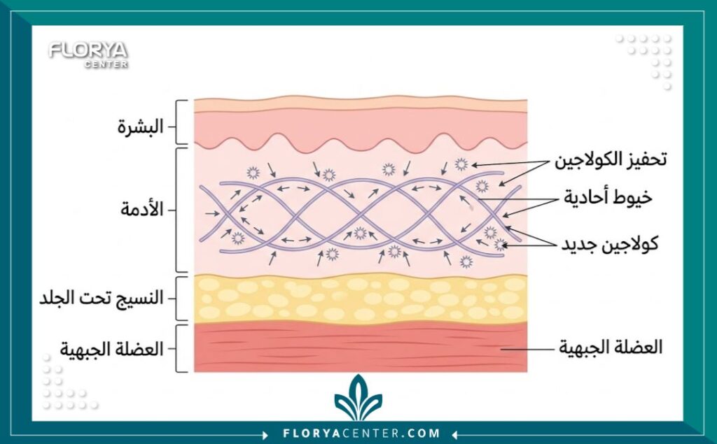 رسم تخطيطي طبي يوضح كيفية زراعة خيوط المونو في طبقات الجلد لشد الجبهة وتحفيز الكولاجين.