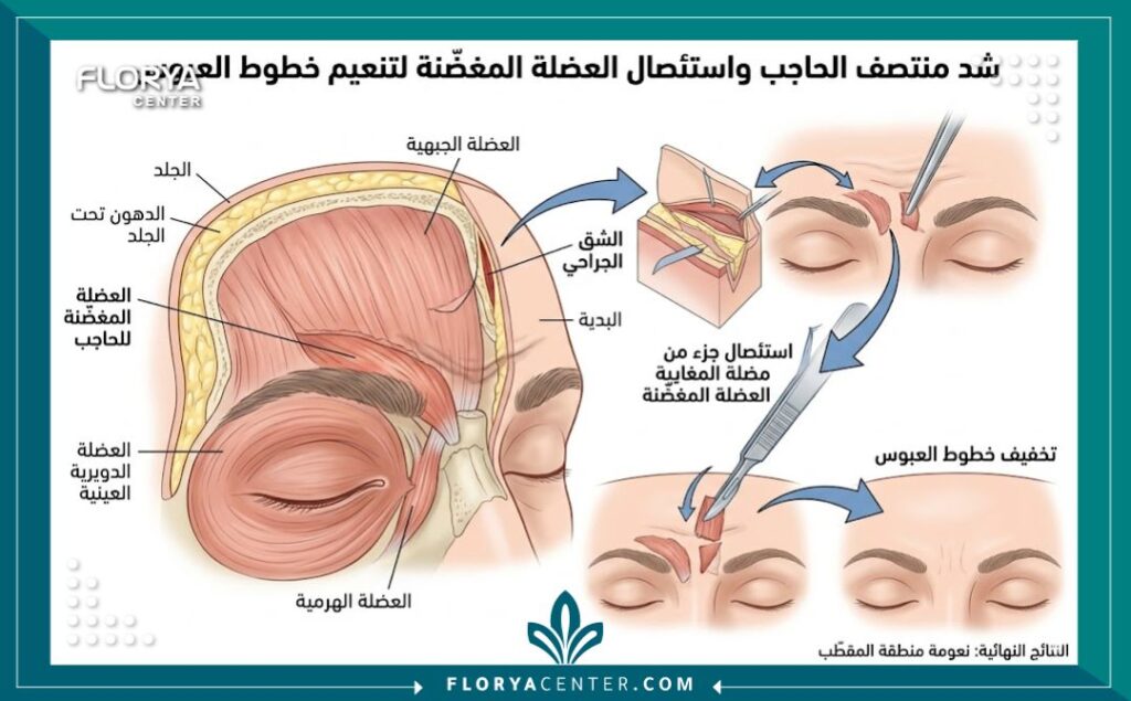 رسم توضيحي طبي دقيق يشرح تشريح عضلات العبوس وخطوات جراحة شد منتصف الحاجب كبديل دائم للبوتوكس.