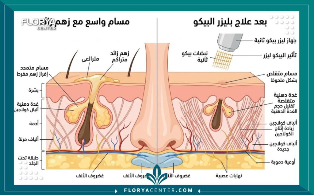 رسم تخطيطي طبي يوضح الفرق بين شكل المسام الواسعة قبل وبعد تأثير ليزر البيكو في تحفيز الكولاجين وتصغير المسام.