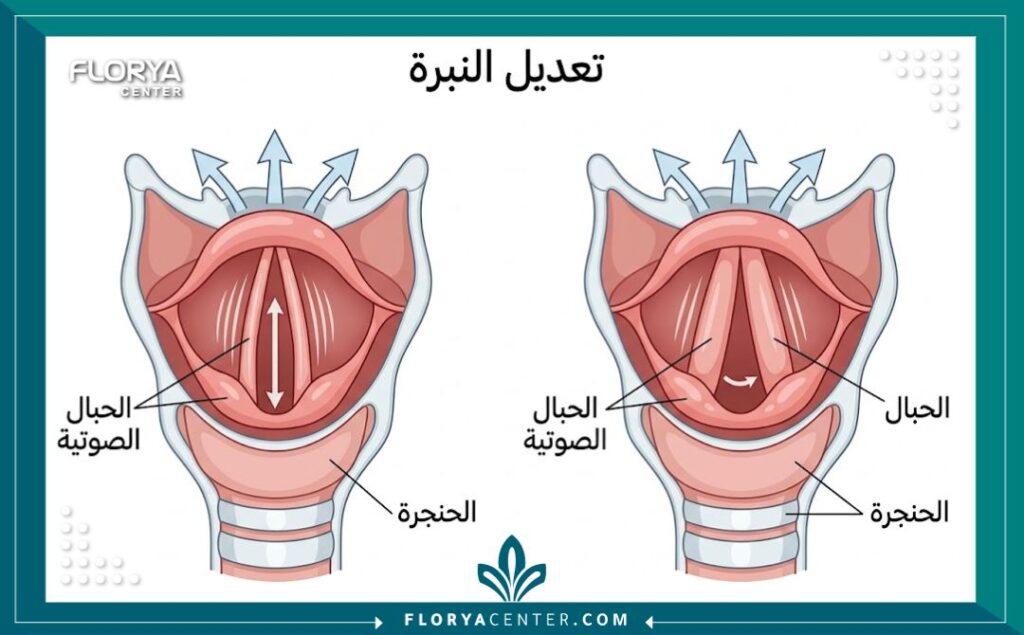 رسم تخطيطي طبي يوضح كيفية علاج النبرة الحادة وتغيير طبقة الصوت في الحنجرة.