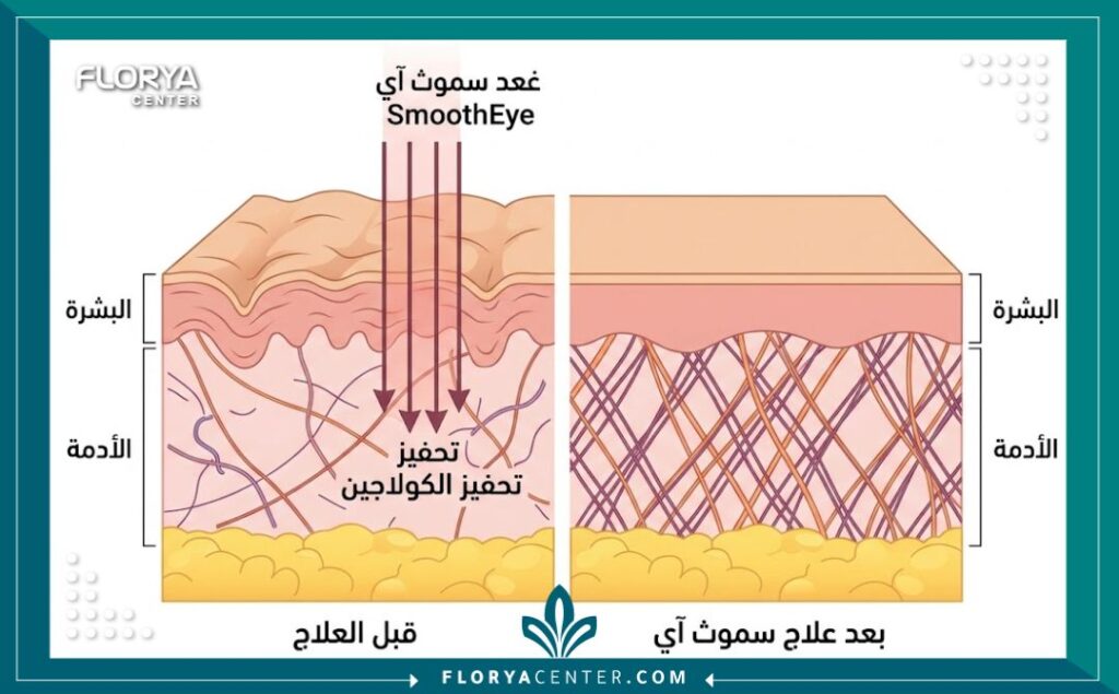 رسم تخطيطي طبي يوضح كيفية عمل ليزر سموث آي لتحفيز الكولاجين وعلاج تجاعيد تحت العين.