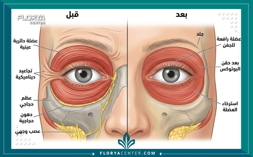 رسم تخطيطي طبي يشرح تشريح عضلات العين وتأثير البوتوكس في إرخاء تجاعيد الضحك.