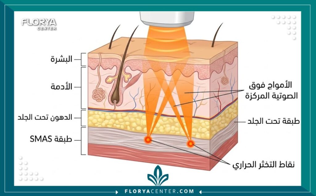 رسم توضيحي طبي يبين كيفية اختراق أمواج الهايفو لطبقات الجلد للوصول إلى طبقة SMAS لشد الخدود المترهلة.