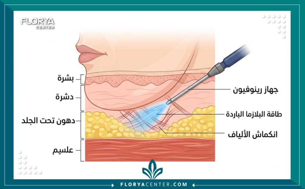 رسم توضيحي طبي يظهر كيفية عمل جهاز رينوفيون (البلازما الباردة) تحت سطح الجلد لشد ترهلات اللغلوغ وتحفيز الكولاجين.