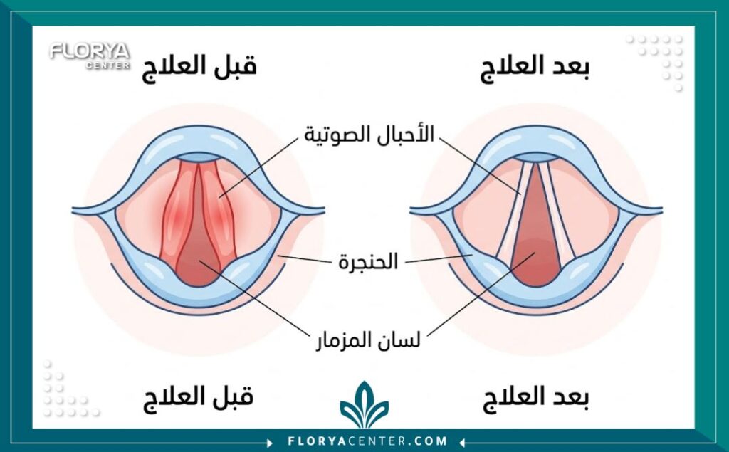 رسم توضيحي طبي يوضح الفرق بين الأحبال الصوتية السميكة المسببة لخشونة الصوت والأحبال الصوتية الرقيقة بعد العلاج الجراحي لترقيق الصوت في تركيا.
