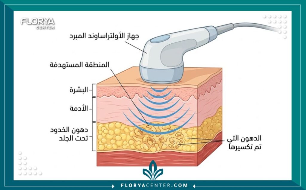 رسم توضيحي طبي يظهر تشريح الخد وكيفية استهداف أمواج الأولتراساوند المبرد لدهون الخد السفلية تحت الجلد لتكسيرها دون جراحة.