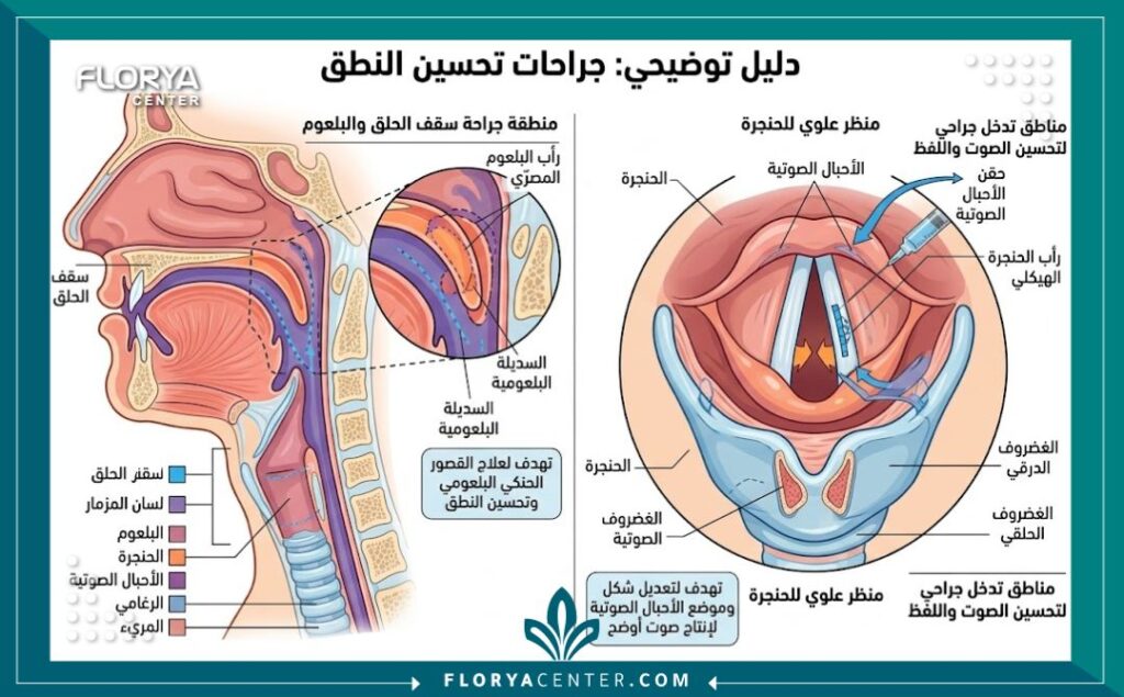 رسم تخطيطي طبي تشريحي يوضح الحنجرة والأحبال الصوتية والمناطق المستهدفة في عمليات تحسين النطق، مع تعليقات بالعربية.