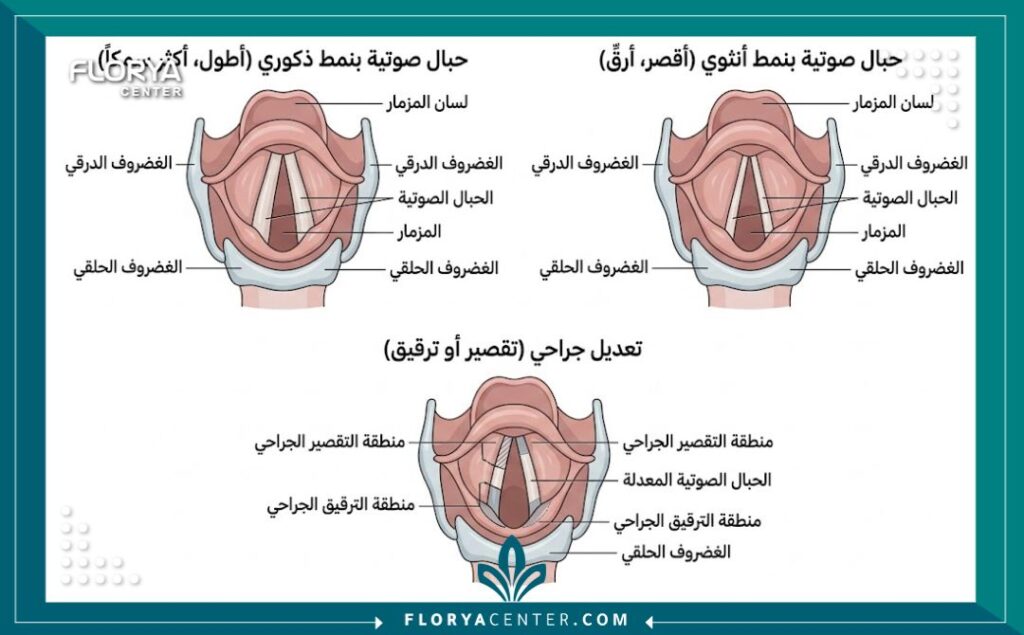 عمليات تغيير الصوت في تركيا 2 مخطط طبي يوضح الفرق التشريحي بين الأحبال الصوتية للرجل والمرأة وكيفية تعديلها جراحيًا لتغيير طبقة الصوت.