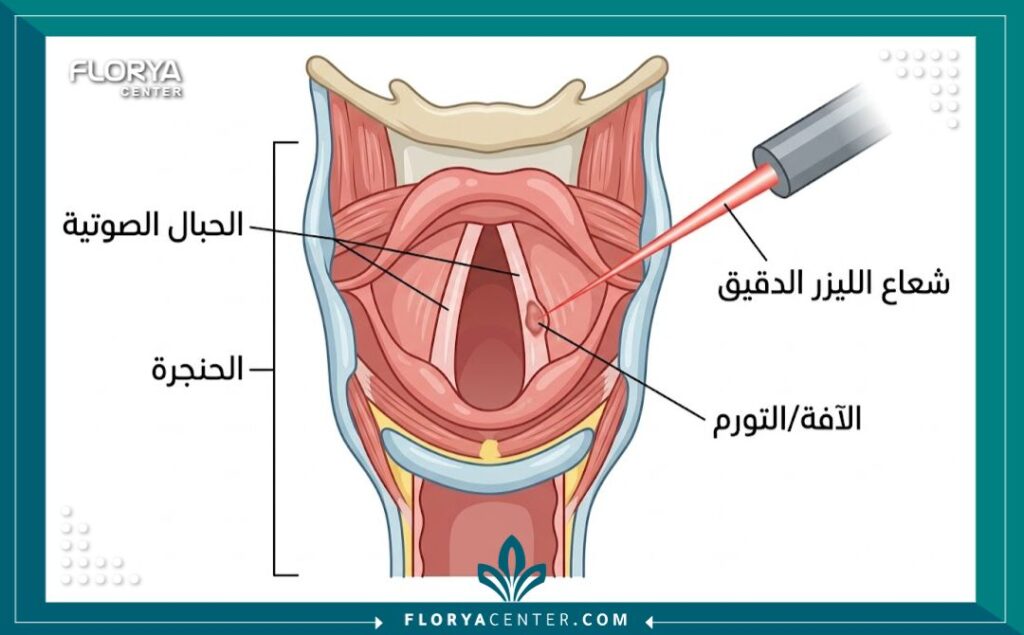 رسم تخطيطي طبي يوضح تشريح الحنجرة وكيفية استهداف شعاع الليزر الدقيق للأنسجة المتضررة في الحبال الصوتية دون المساس بالأنسجة السليمة.