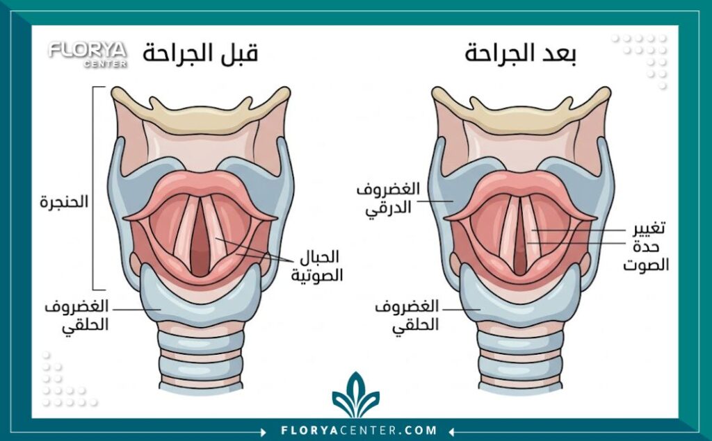 رسم توضيحي طبي لتشريح الحنجرة والحبال الصوتية قبل وبعد عملية تجميل الصوت
