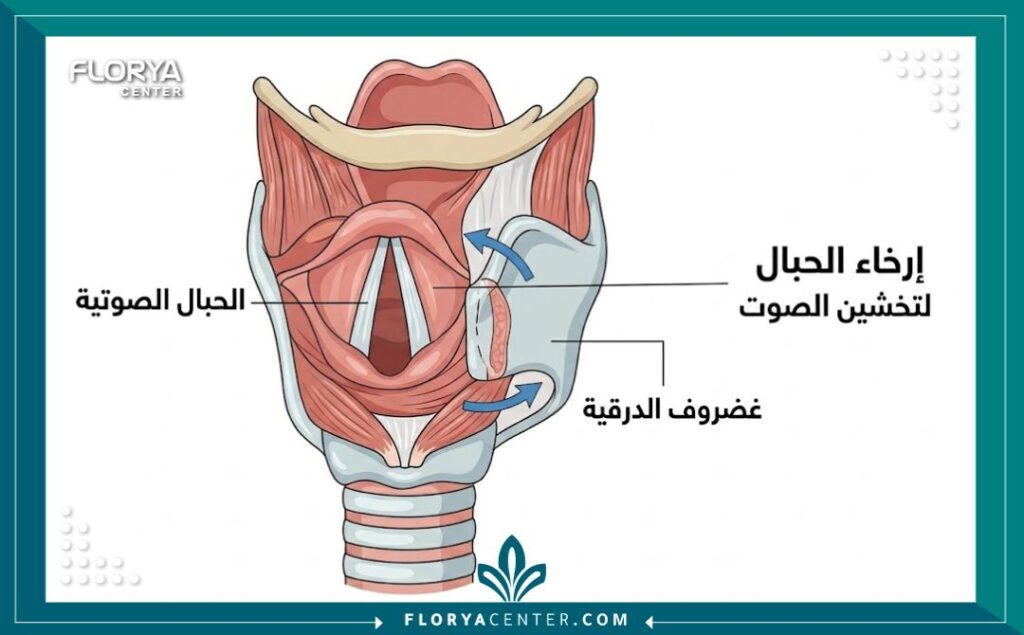 رسم تخطيطي يوضح كيفية إرخاء الحبال الصوتية في عملية تخشين الصوت