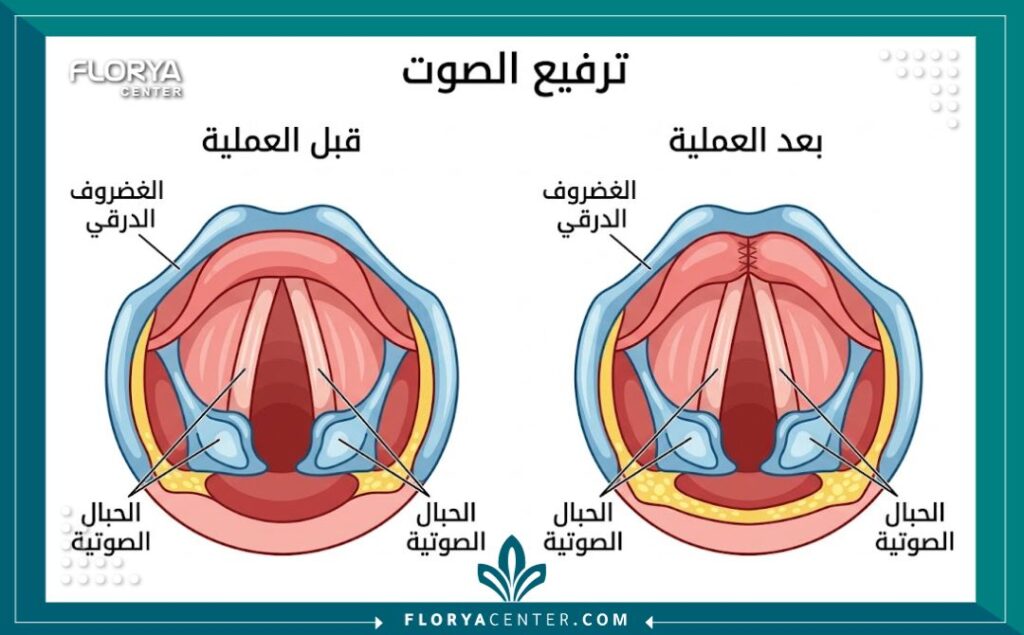 رسم تخطيطي طبي يوضح تشريح الحنجرة والحبال الصوتية قبل وبعد عملية ترفيع الصوت وتنعيمه في تركيا، يوضح كيفية تقصير وشد الحبال.