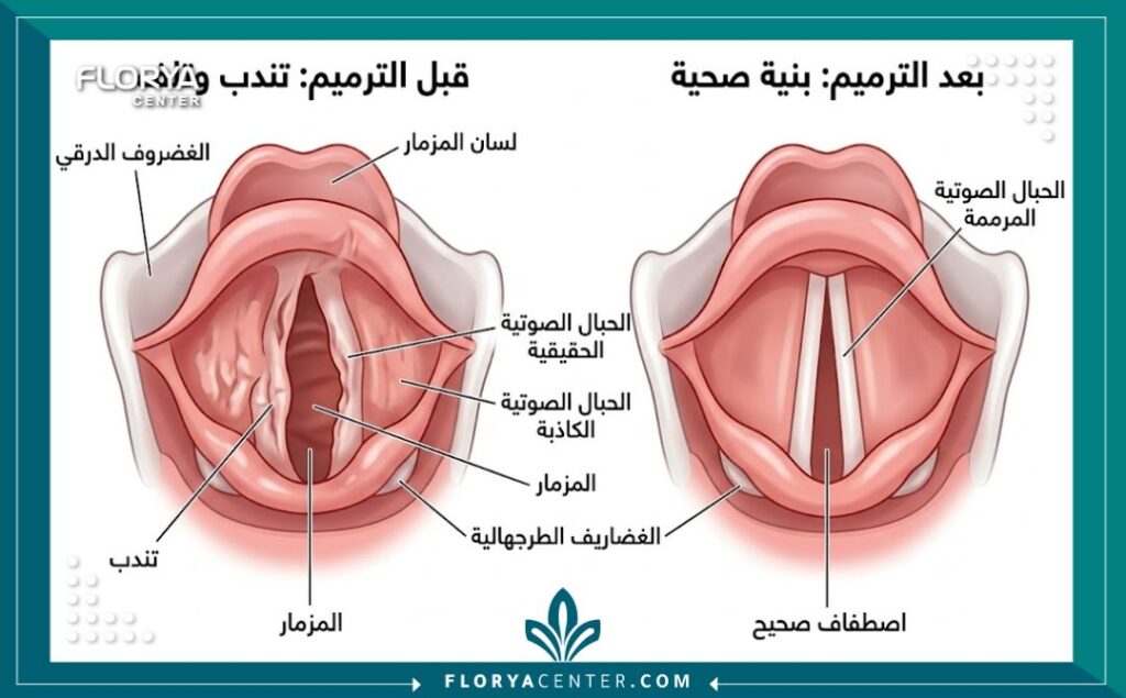 رسم تخطيطي طبي يقارن بين شكل الحبال الصوتية المتضررة والمصابة بتندب، وشكلها بعد إجراء عملية الترميم الجراحي الدقيق لإصلاح الصوت.