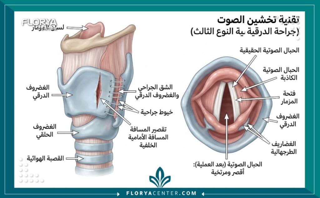 رسم تخطيطي طبي يوضح تشريح الحنجرة والأحبال الصوتية وكيفية إجراء عملية تضخيم الصوت لتخفيض حدة الصوت.