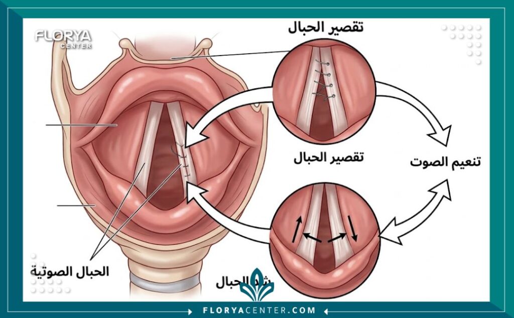 رسم تخطيطي طبي يوضح تشريح الحنجرة وآلية عملية تنعيم الصوت من خلال شد وتقصير الحبال الصوتية لرفع الطبقة الصوتية.