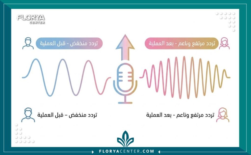 انفوجرافيك يقارن بين تردد الصوت المنخفض قبل العملية والتردد المرتفع والناعم بعد عملية تنعيم الصوت وتحقيق الأنوثة الصوتية.