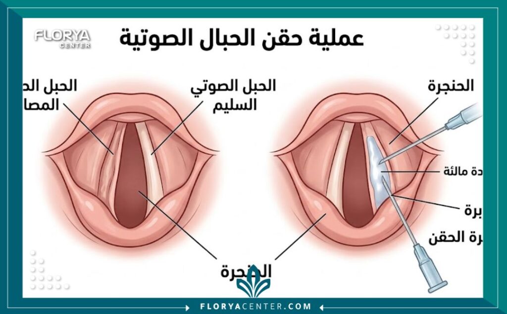رسم طبي تشريحي يوضح عملية حقن المواد المالئة داخل الحنجرة لزيادة حجم الحبل الصوتي المشلول أو الضامر، مع تسميات عربية دقيقة.