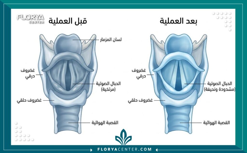 رسم تخطيطي طبي يوضح الفرق بين الحبال الصوتية الارتخاء ومشدودة تماماً كأوتار الجيتار بعد الجراحة.