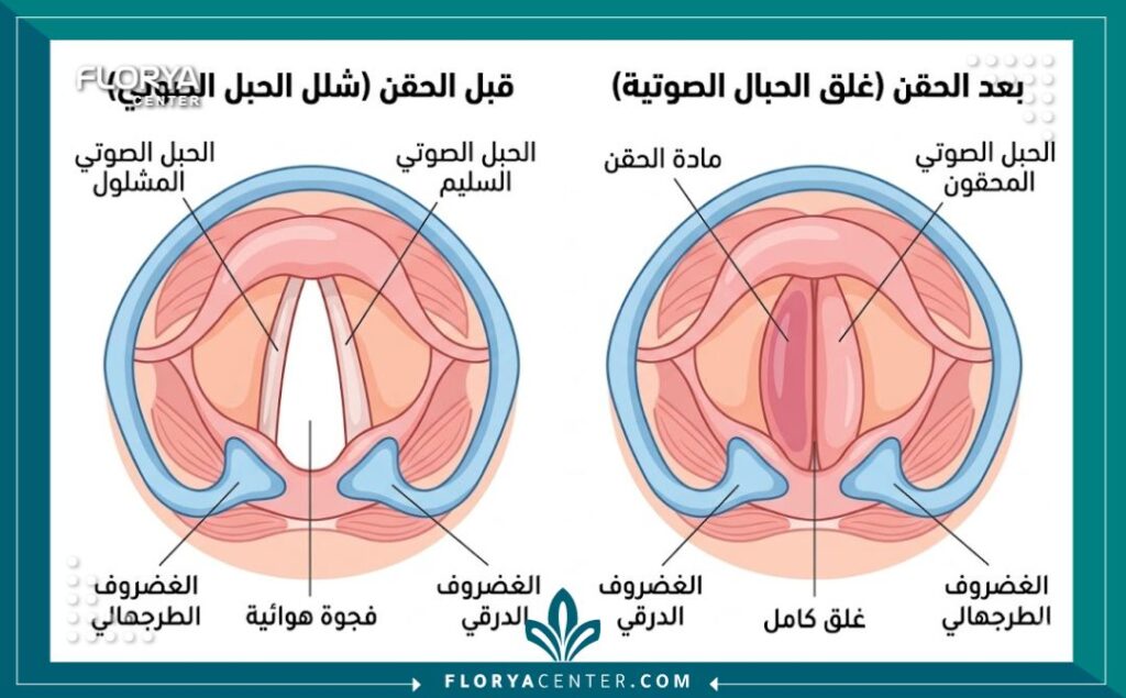 مخطط طبي يوضح الفرق بين الحبال الصوتية قبل وبعد الحقن، وكيف تساعد مادة الفيلر في غلق الفجوة لتحسين الصوت.