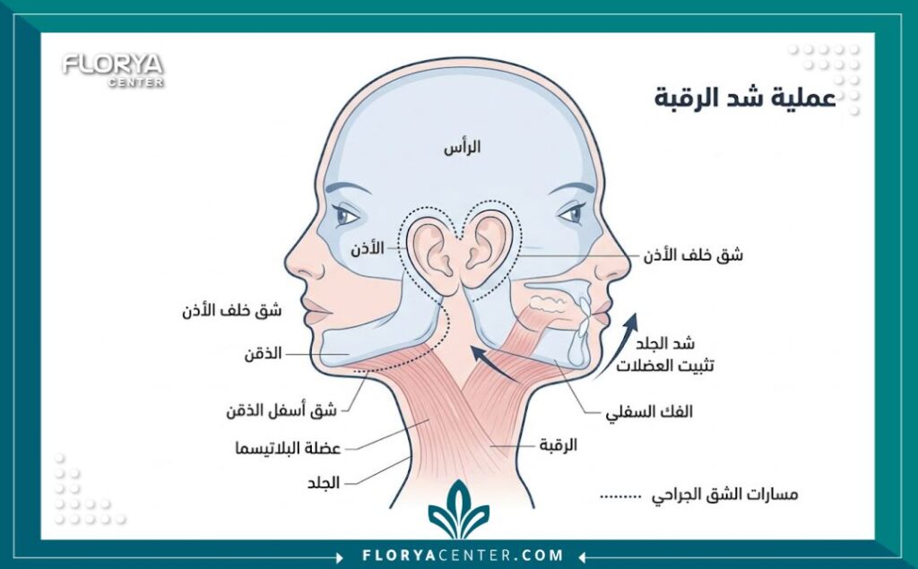 رسم توضيحي طبي يبين مكان الشق الجراحي لعملية شد الرقبة المخفي تحت الذقن وخلف الأذن.