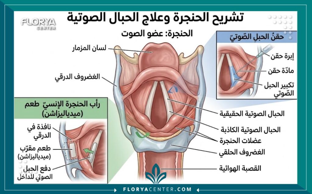 مخطط تشريحي طبي يوضح الحنجرة والحبال الصوتية ومكان إجراء عملية تجميل الصوت.