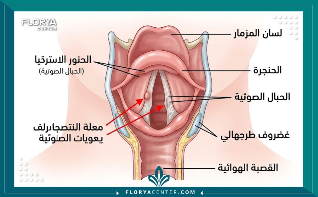 رسم توضيحي طبي يظهر تشريح الحنجرة والحبال الصوتية ومكان إجراء العملية الجراحية.