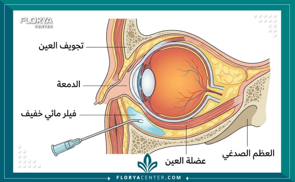 إنفوجرافيك يقارن بين خصائص ومزايا الفيلر المائي الخفيف للعين مقابل الفيلر التقليدي الكثيف من حيث التكتل والنعومة.
