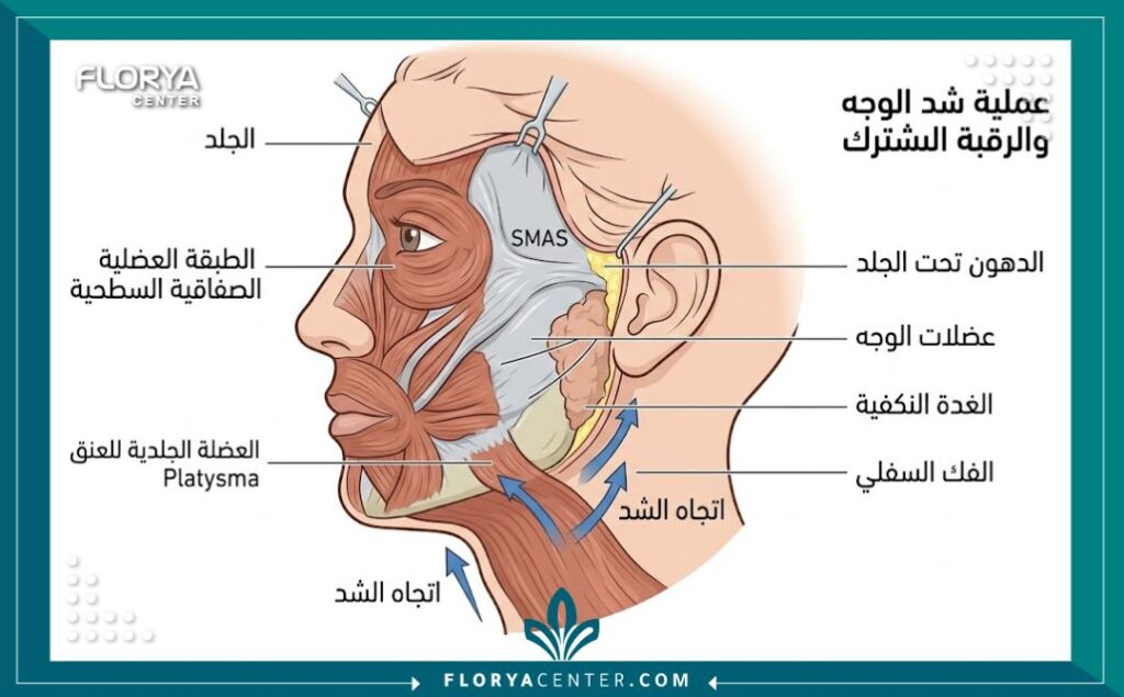 رسم توضيحي طبي يبين العضلات والأنسجة المستهدفة في عملية شد الوجه والرقبة المزدوجة لشد الترهلات.