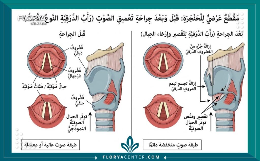 رسم تخطيطي طبي يوضح التغيرات التشريحية في الحبال الصوتية بعد عملية تغيير نبرة الصوت بشكل دائم.