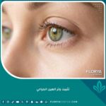 صورة مقربة تبرز جمال وشد الجفن السفلي والزاوية الخارجية للعين بعد عملية تثبيت وتر العين الجراحي.