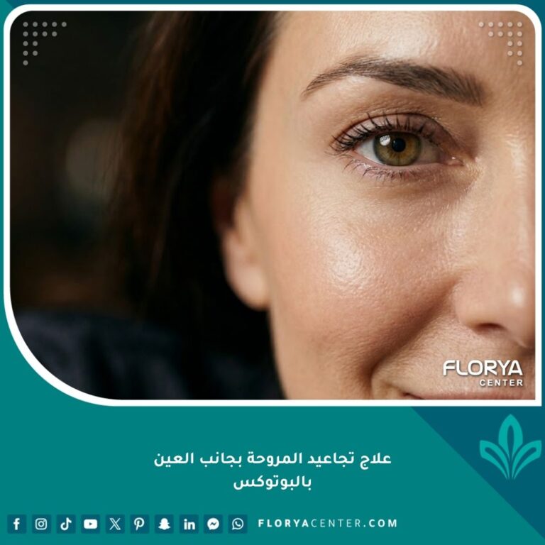 صورة احترافية تظهر نتيجة علاج تجاعيد المروحة بجانب العين بالبوتوكس بشرة ناعمة ومشدودة.