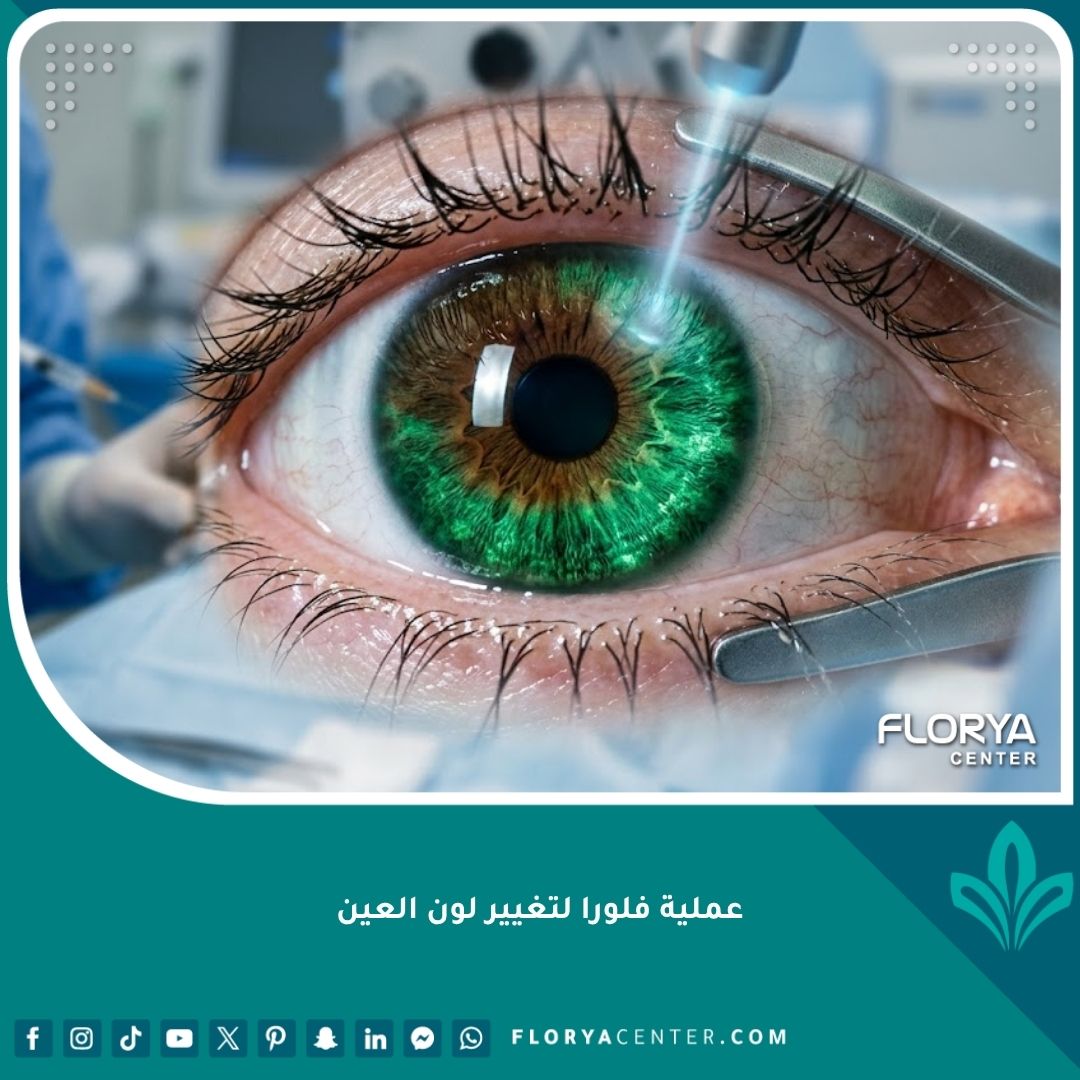 لقطة سينمائية مكبرة لعملية فلورا لتغيير لون العين (تصبيغ القرنية) وهي تتحول من البني إلى الأخضر الزمردي.