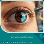 صورة سينمائية قريبة تظهر عملية تحول لون العين من البني إلى الأزرق الفاتح باستخدام تقنية تفتيت الميلانين بالليزر، تبرز جمالية النتيجة قبل وبعد.