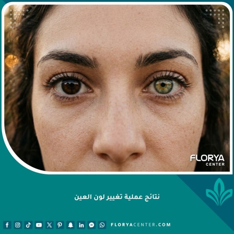 صورة مقربة جداً تظهر نتائج واقعية لعملية تغيير لون العين من البني إلى العسلي المخضر، تبدو طبيعية تماماً وغير مصطنعة.