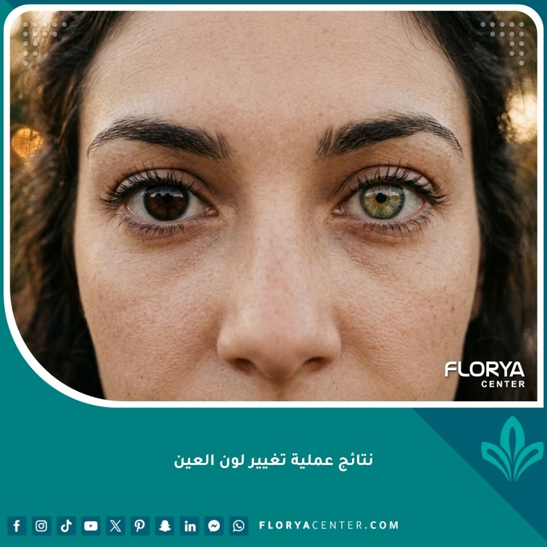 صورة مقربة جداً تظهر نتائج واقعية لعملية تغيير لون العين من البني إلى العسلي المخضر، تبدو طبيعية تماماً وغير مصطنعة.