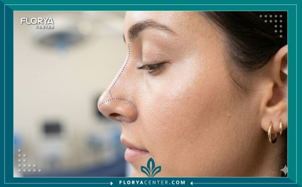لقطة قريبة لأنف سيدة مع تخطيط جراحي دقيق يوضح صعوبة العملية لتجنب فشل تجميل الأنف.