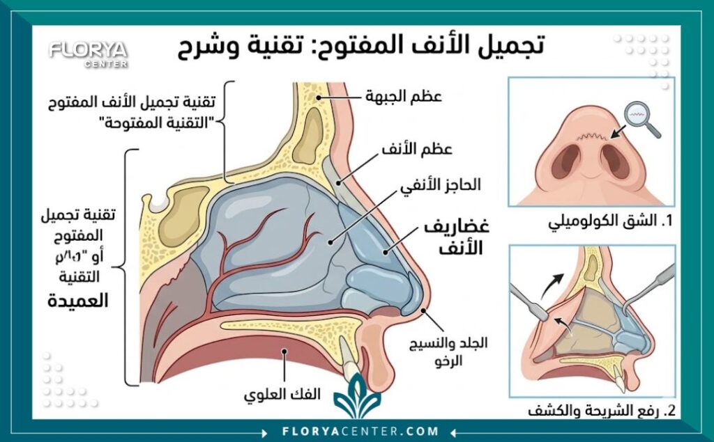مخطط توضيحي لتقنية عملية تجميل الأنف المفتوح وهيكل غضاريف الأنف.
