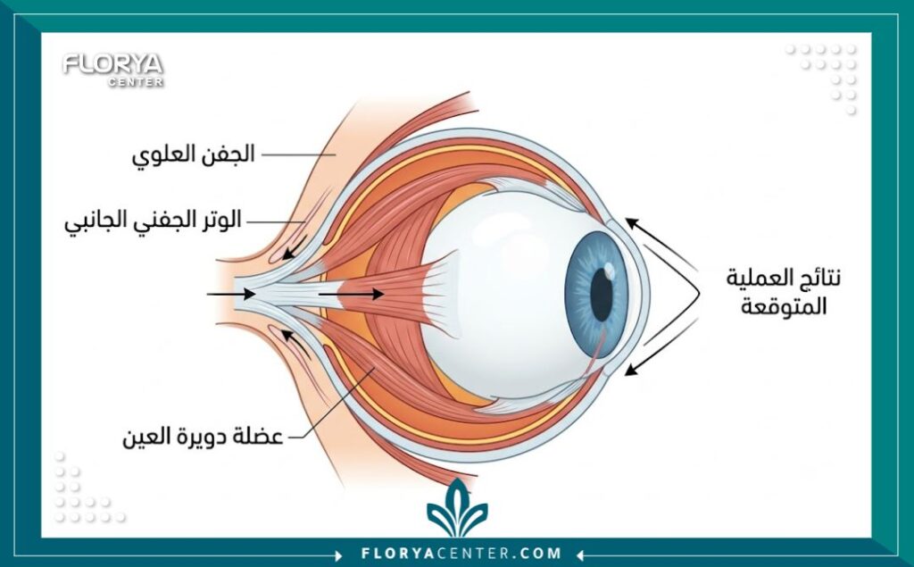 توضيح طبي لجراحة العيون اللوزية: تشريح العين وعملية شد الوتر الجفني للحصول على شكل العين اللوزية في تركيا