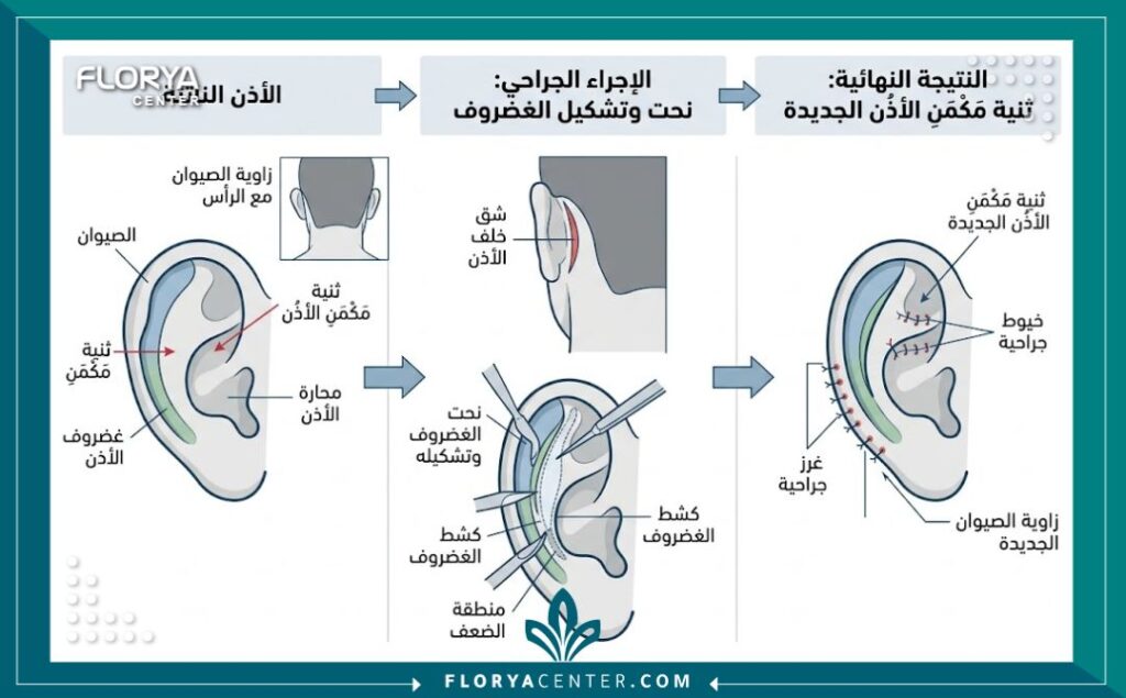 مخطط طبي تشريحي يوضح عملية تعديل غضاريف الأذن وتصغير الأذن البارزة للرجال.