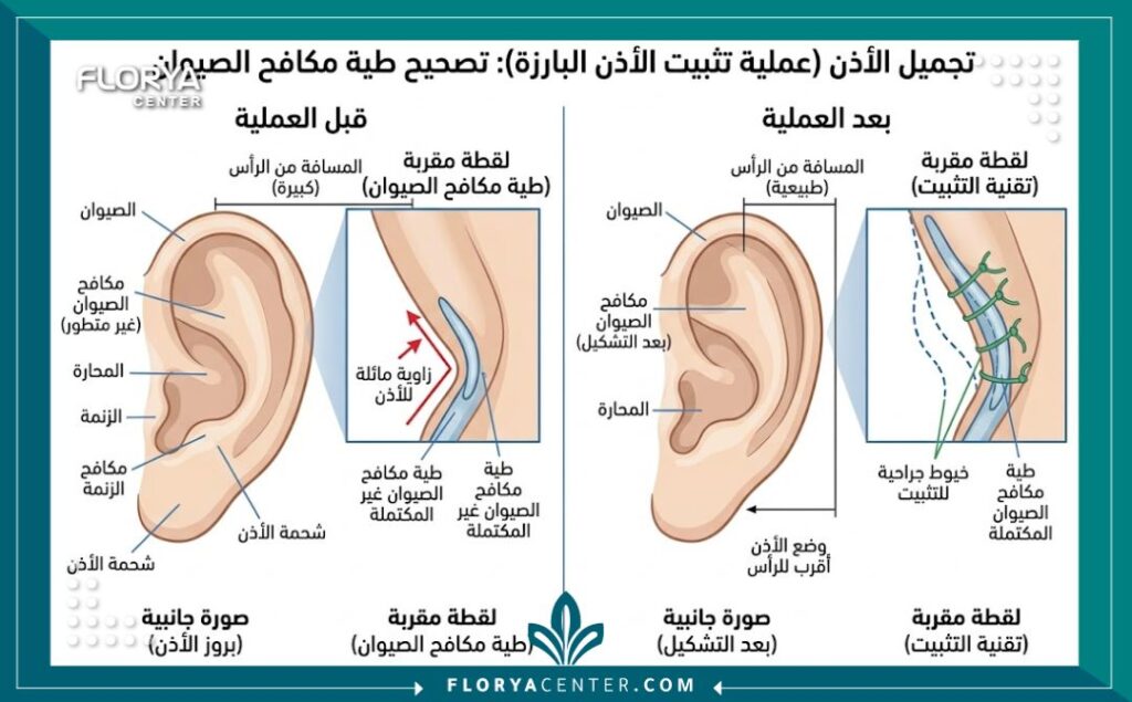 مخطط طبي يوضح تشريح الأذن قبل وبعد عملية تجميل الأذن الخفاشية.
