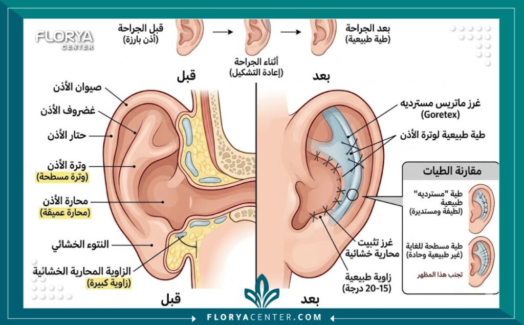 أفضل جراح تجميل أذن في تركيا 2 رسم توضيحي طبي لتشريح الأذن يوضح تقنية طي الغضروف في عملية تجميل الأذن البارزة.