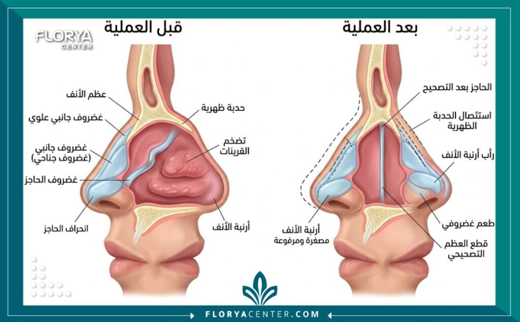 رسم توضيحي طبي لتشريح الأنف وخطوات عملية تجميل الأنف بأحدث التقنيات.