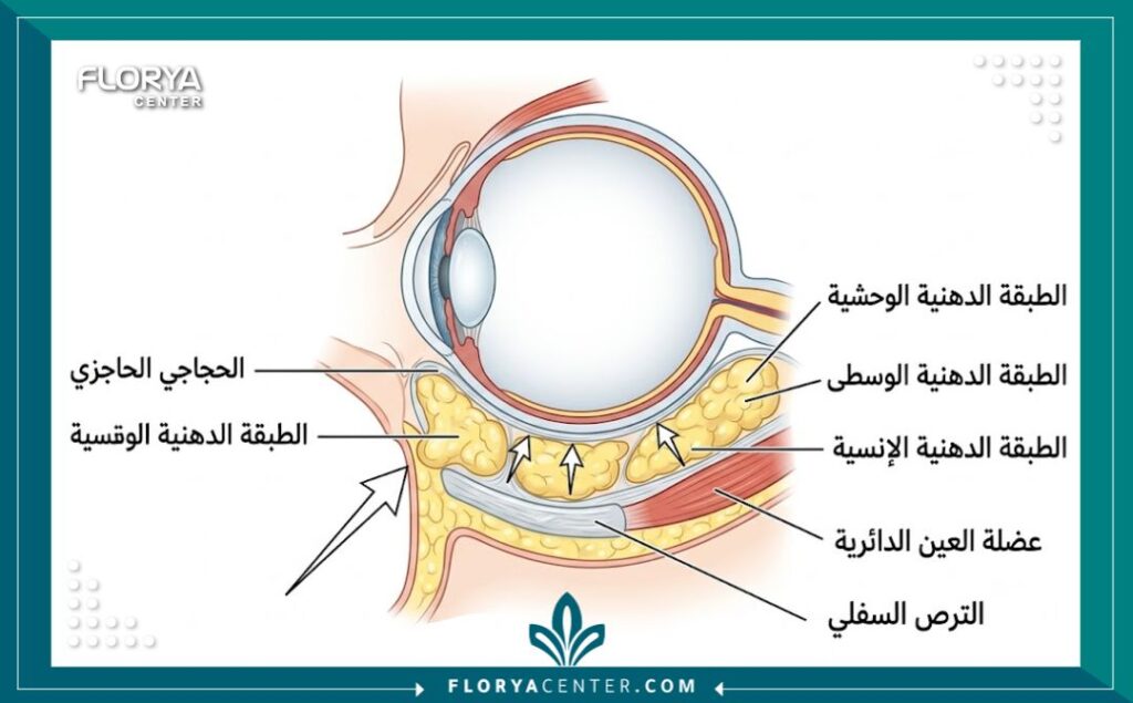 رسم طبي توضيحي مقطعي يظهر بنية الجفن السفلي والدهون تحت العين (الوسادات الدهنية الثلاث) وموقع الحاجز الحجاجي وعضلة العين الدائرية، يشرح تشريح العين قبل عملية إزالة الانتفاخات.