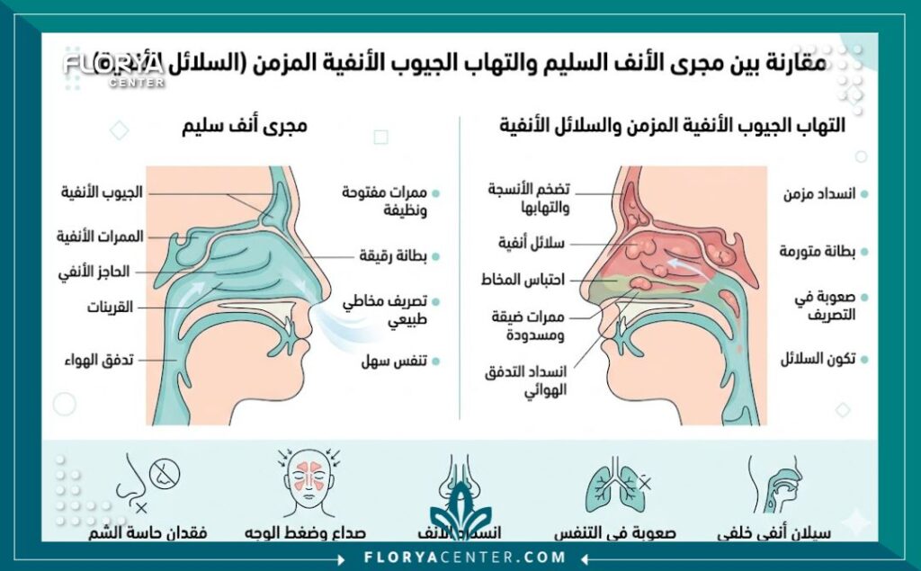 استئصال الزوائد الأنفية (اللحمية) 3 إنفوجرافيك طبي يقارن بين الممرات الأنفية السليمة والمصابة بالزوائد الأنفية مع توضيح أعراض التهاب الجيوب الأنفية المزمن.